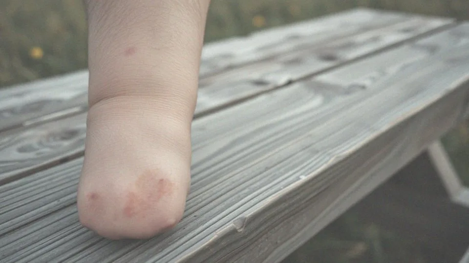 Oparzenie słoneczne ile trwa? Czas gojenia w zależności od stopnia